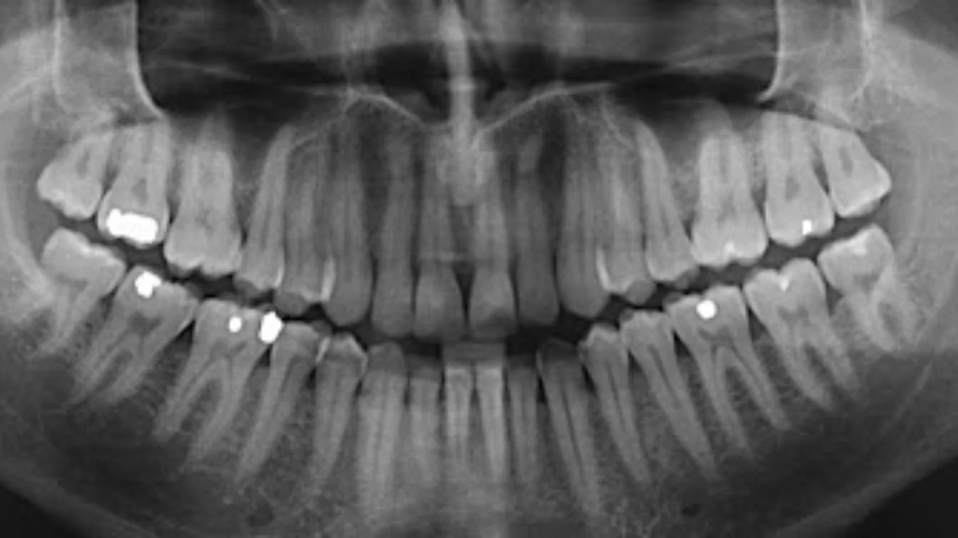 Dental X-Rays (3)